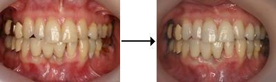 歯周形成外科による歯肉の改善
