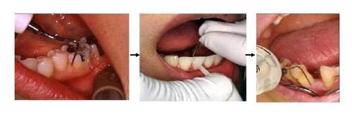 歯周病治療における歯石除去（スケーリング）の流れ