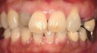 歯の形・色・長さ・歯ぐきの高さの不揃い・歯ぐきの凹みの改善前
