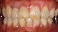歯の形・色・長さ・歯ぐきの高さの不揃い・歯ぐきの凹みの改善後