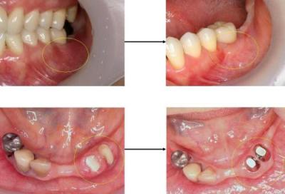 歯周形成外科による歯肉の改善