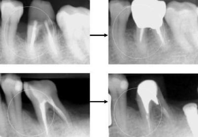 歯槽骨の再生