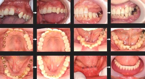 歯科インプラント治療症例