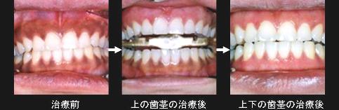 歯ぐきのホワイトニング（ガムホワイトニング）