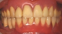 歯の形・色・長さ・歯ぐきの高さの不揃い・歯ぐきの凹みの改善後