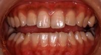 治療前の歯の色